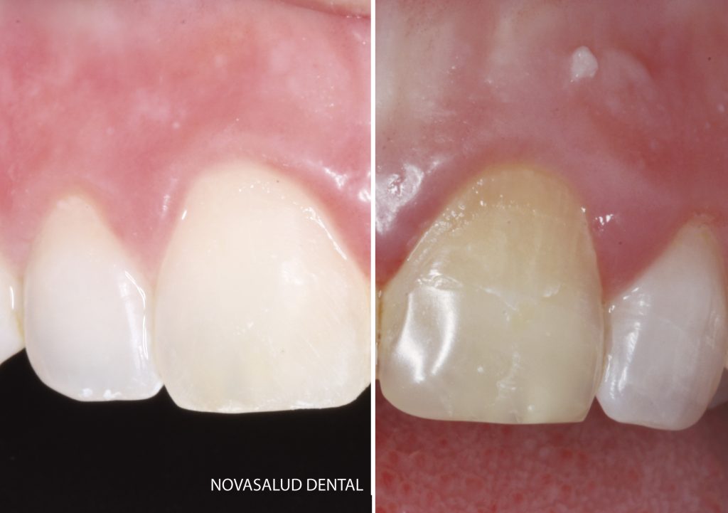 Blanqueamiento Dental Interno En Diente No Vital